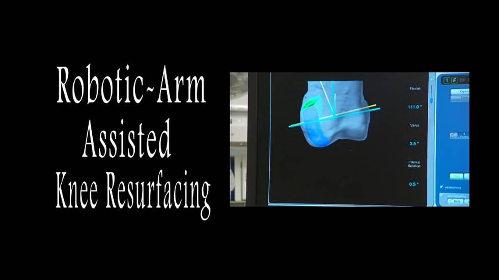 robotic knee prosthesis on monitor